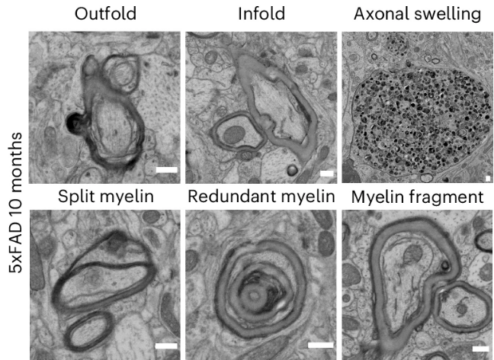 Age-related myelin damage